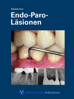 cover image of Endo-Paro-Läsionen